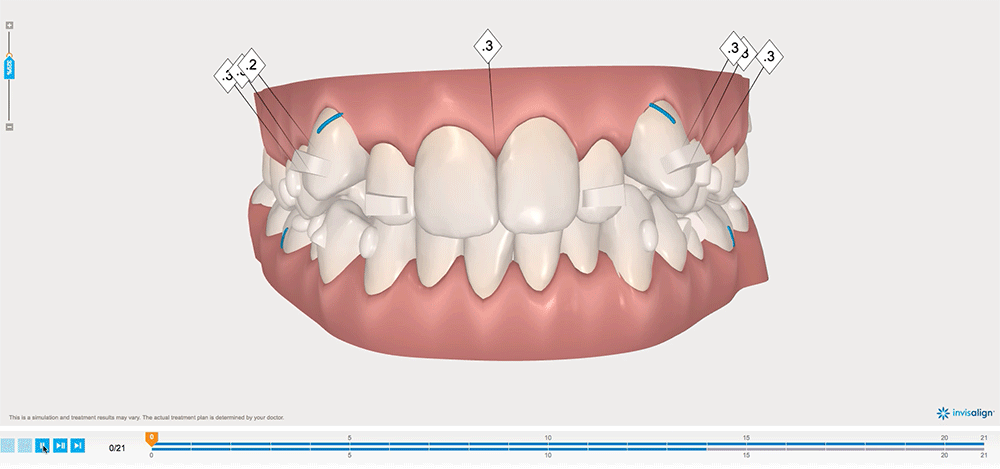 InvisalignAnimation